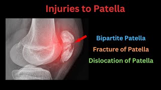 Injuries to Patella Bipartite patella Patella fracture amp Dislocation of patella Complete Guide [upl. by Elodia]