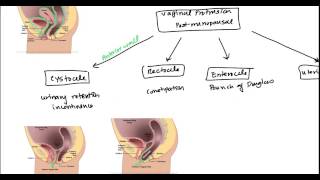 Uterine Prolapse and Vaginal Prolapse for USMLE [upl. by Ziom117]