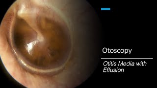 Otitis Media with Effusion Otoscopy [upl. by Jacobs]