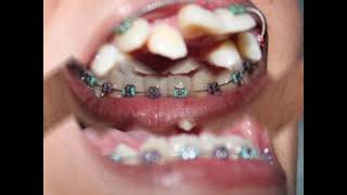 My Braces May June 2012wmv [upl. by Gelman]