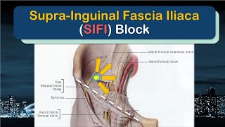 SupraInguinal Fascia Iliaca SIFI Block  the SUPRAINGUINAL approach [upl. by Bone]