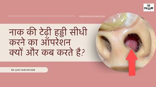 Ep1 Deviated Nasal Septum I नाक की हड्डी का ऑपरेशन I Septoplasty I naak ki haddi ka operation [upl. by Yerg]