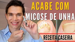 ACABE com a MICOSE DE UNHA  3 tratamentos CASEIROS [upl. by Enelyw]