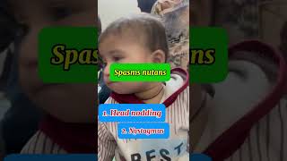 Spasmus nutans syndrome  Head nodding in babies [upl. by Colb407]