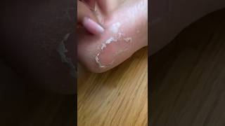 Crazy and Satisfying Peeling after using the Plantifique Foot Peel Mask ✨ Baby Soft Feet in 7 Days [upl. by Akemyt]