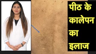 पीठ के कालेपन का कारण व इलाज । Back darkness removal  Dark Back Treatment । Maculer amyloidosis [upl. by Anauqaj570]