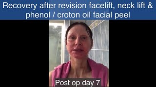 My Video Diary Part 2  Revision facelift necklift amp facial phenol  croton oil peel  Week 2  4 [upl. by Eula]