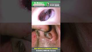 Homeopathy No Surgery Say no to surgery Pain Best medicine Nasal polyp DrNisha Surgery [upl. by Sucramal]