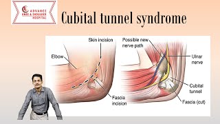 Cubital Tunnel Syndrome Everything You need to know [upl. by Ahtnahc]