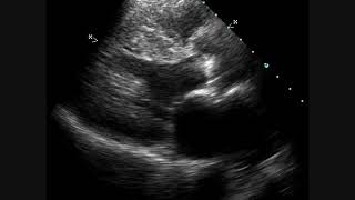 Calcific Aortic Stenosis  Echocardiogram [upl. by Alam]