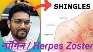 Herpes Zoster Virus in hindi shingles  viral skin infection  symptoms  treatment [upl. by Bej]