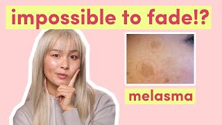 Melasma amp hyperpigmentation  What can you do to fade melasma [upl. by Ained]