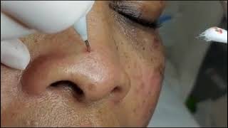 101 Filiform Wart Removal on nose Skin type VI [upl. by Einwahr]