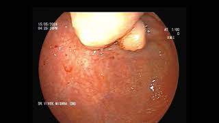 कोलोनोस्कोपी करने पर मिला बड़ी आंत में गांठ  Colonic polypoidal lesion at cecum  GASTROLIVER [upl. by Bertrando]