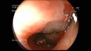 Managing Live Leech and Roundworm Endobronchial Infestation [upl. by Teresita]