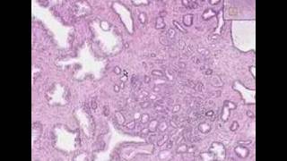 Histopathology Prostate Adenocarcinoma Gleason grade 2 [upl. by Nolahs168]