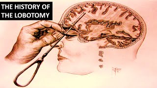 The Rise and Fall of The Lobotomy [upl. by Einnaj]