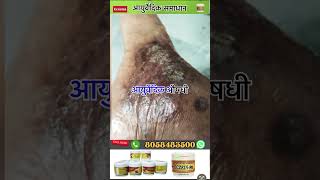 Eczema ayurvedic skin care eczema skincare eczematreatment trending song ayurveda skincare [upl. by Elgar]