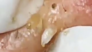 Deep blackhead extraction Cystic acne amp pimple popping 78 [upl. by Akinam]