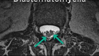 Tspine MRI Type II Diastematomyelia [upl. by Rhianna358]