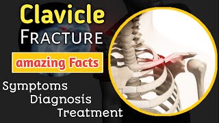 Clavicle fracture  Everything you need to know  Symptoms  Diagnosis  Treatment [upl. by Drannel104]