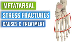 Metatarsal Stress Fractures  Causes Treatment Prevention [upl. by Adnwahsat611]