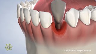 General Extractions with Dr Rehrer at Beacon Oral amp Maxillofacial Surgeons [upl. by Enrak]