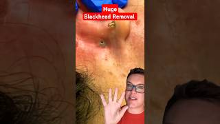 🥇 The Perfect BLACKHEAD REMOVAL 2024 shorts [upl. by Jeremy]