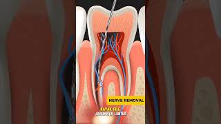 Nerves removal tooth RCT treatment [upl. by Poock]