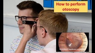 How to perform Otoscopy Ear Exam [upl. by Nael453]