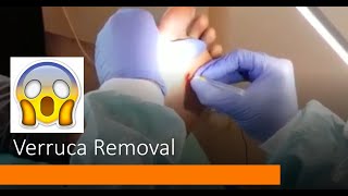 Verruca Needling Curing a 10 year Verruca Verruca Removal  Abid Hussain Podiatrist [upl. by Yelsnya]