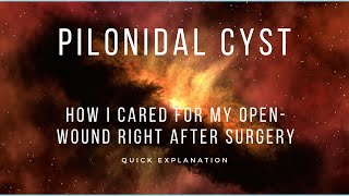 Pilonidal Cyst Open Wound Care My First Gauze Change [upl. by Swayne]