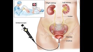 Endoscopic Lithotripsy kidney stones Removal [upl. by Annayak]