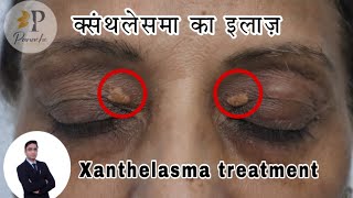 Xanthelasma Surgery in Delhi  Xanthelasma Treatment  Xanthelasma Removal  xanthelasma [upl. by Edan101]