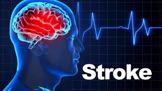 Stroke  Cerebrovascular Accident CVA [upl. by Bethena]