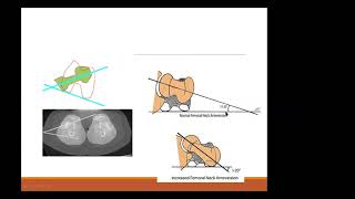 ANTEVERSION FEMORAL Y TORSION TBIAL [upl. by Sirref]