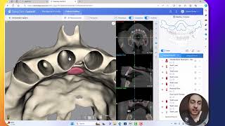 Assessment of buccal plate thickness from CBCT using AI [upl. by Fortin]