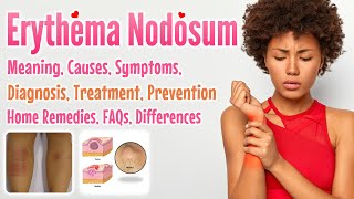 Erythema Nodosum meaning causes symptoms diagnosis treatment prevention home remedies FAQs [upl. by Bil]