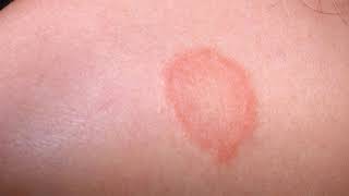 Difference Between Eczema and Ringworm [upl. by Declan938]