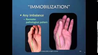 Thumb CMC Osteoarthritis Surgical amp Post Surgical Insights Preview [upl. by Venus235]