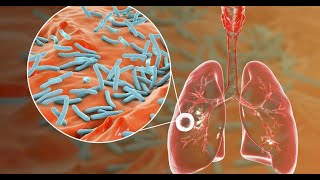 Tubercular Liver Abscess A Rare Entity [upl. by Umont]