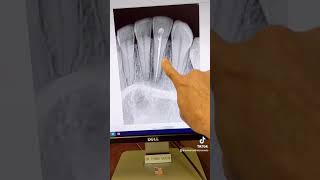 Endodontic retreatment of tooth 23 [upl. by Houston504]