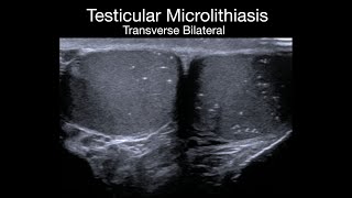 Testicular Microlithiasis [upl. by Rubin]