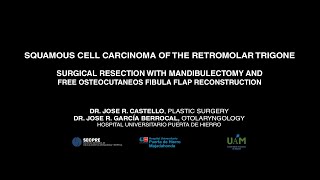 Squamous cell carcinoma of the retromolar trigone Resection and free fibula flap reconstruction [upl. by Bradway190]