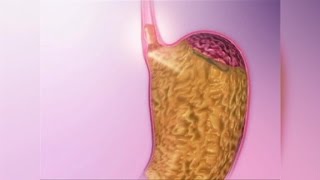 Acid Reflux Natural Remedies [upl. by Meredithe]