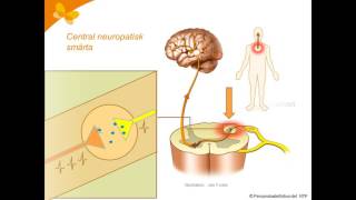 5 neuropatisk smärta [upl. by Agata]