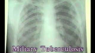 217 Miliary Tuberculosis  Chest XRays  Dr Vaidya [upl. by Enilesor]