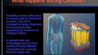 Cellulite Dr Treacy lecture on VelasmoothPPT [upl. by Ellison]