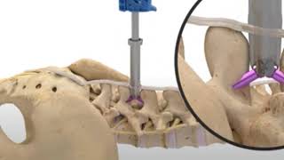 Case Review Series 82 yearold Female with Lumbar Stenosis Fusion or Laminectomy [upl. by Presber491]