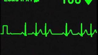 Nodal Trigeminy  ECG Simulator  Arrhythmia Simulator [upl. by Firestone]